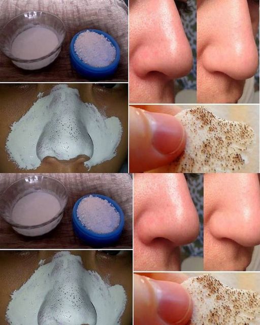 Use A Few Ingredients, They Will Help You Say Goodbye To Big Pores 1 Use A Few Ingredients, They Will Help You Say Goodbye To Big Pores