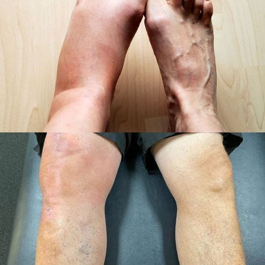 1 Vitamin for Removing Swelling from the Body 1