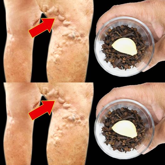 Use Garlic and Cloves to Naturally Remove Varicose Veins 1