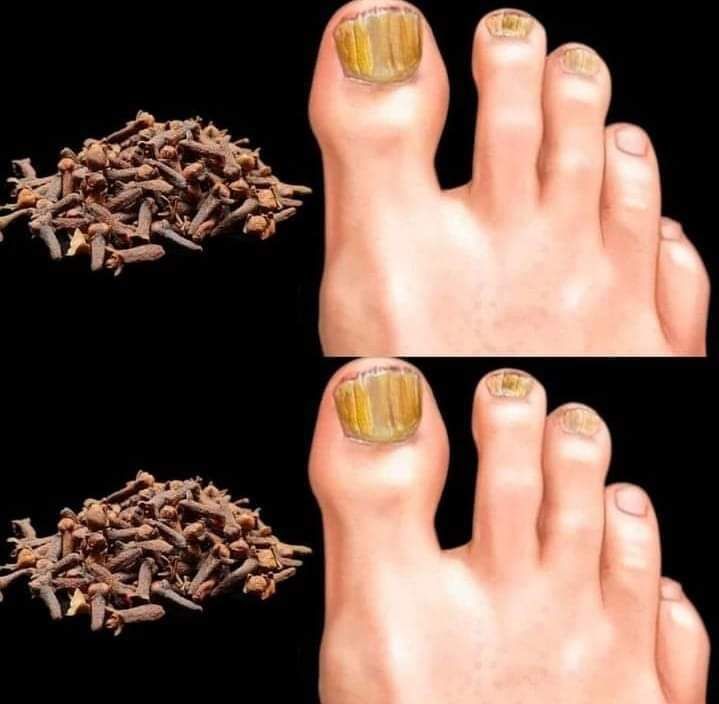 Removes Nail Fungus Instantly, Like an Eraser 1
