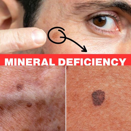 Your Age Spots Are Caused by This Mineral Deficit: The Significance of Selenium 1