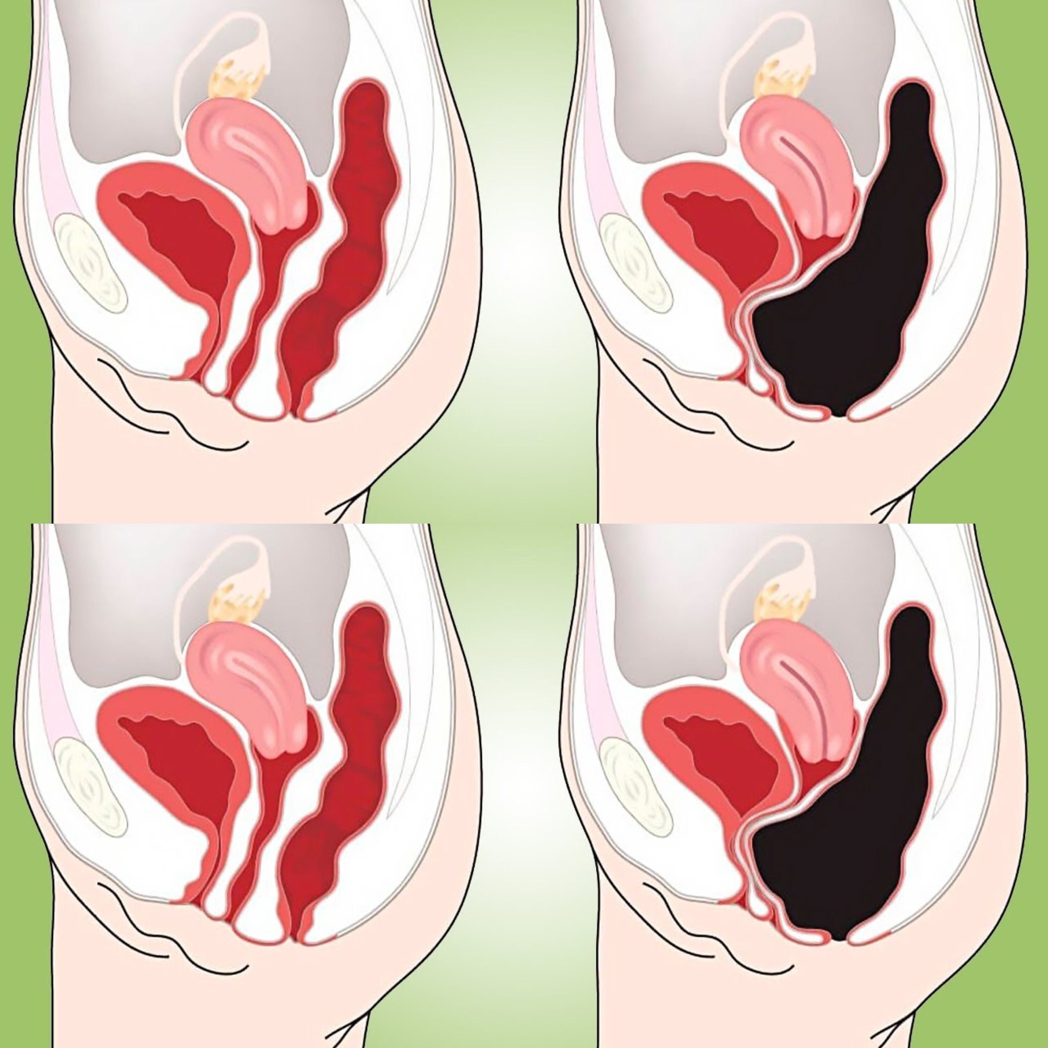 How to Naturally Cleanse Your Colon at Home 1