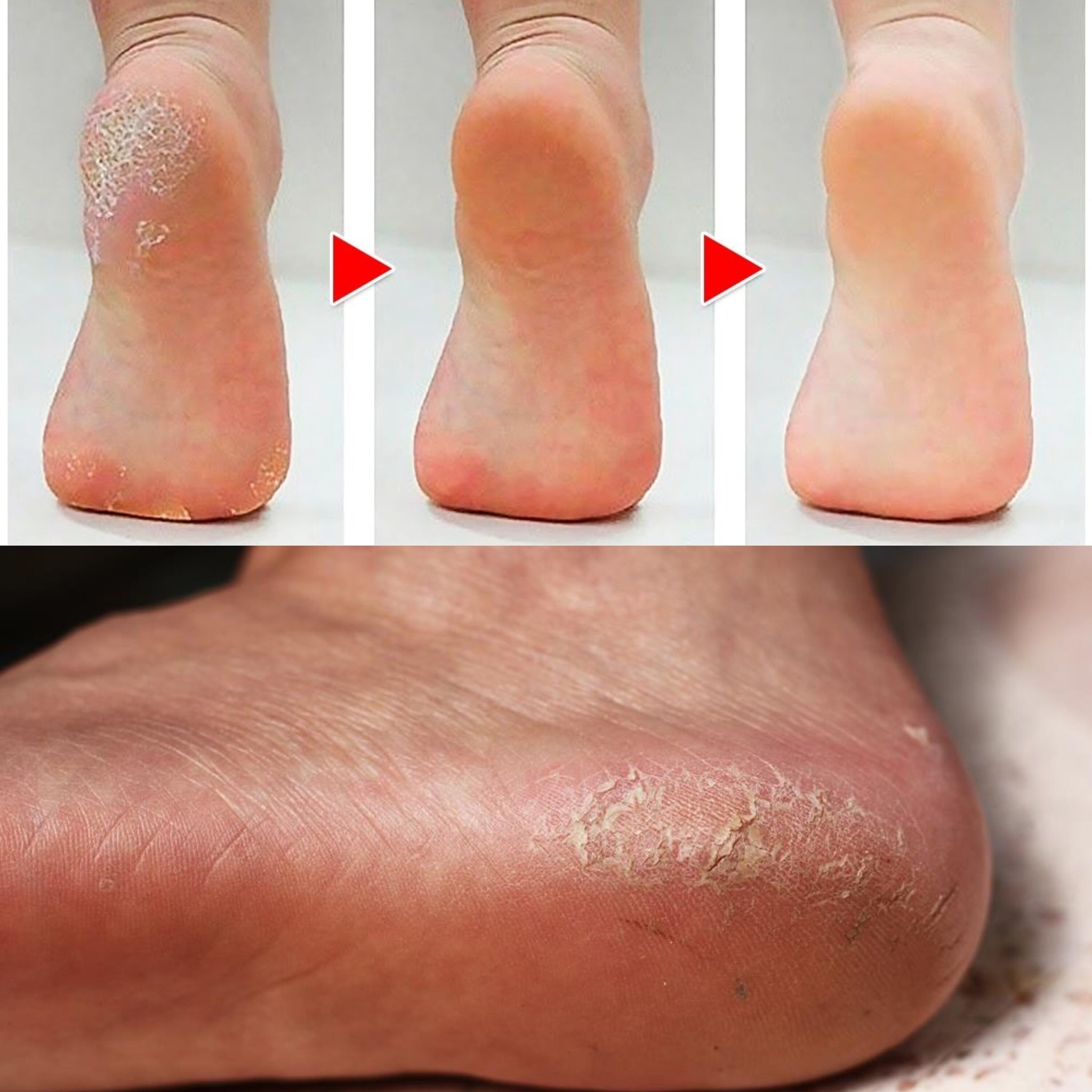 How to Remove Calluses on Feet Naturally 1
