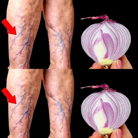 Onions are a natural remedy for varicose veins. 1