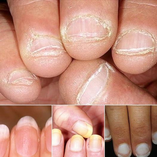 What Your Nails Reveal About Your Health 1