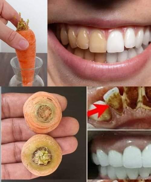 Teeth Whitening in Just Two Minutes: 8