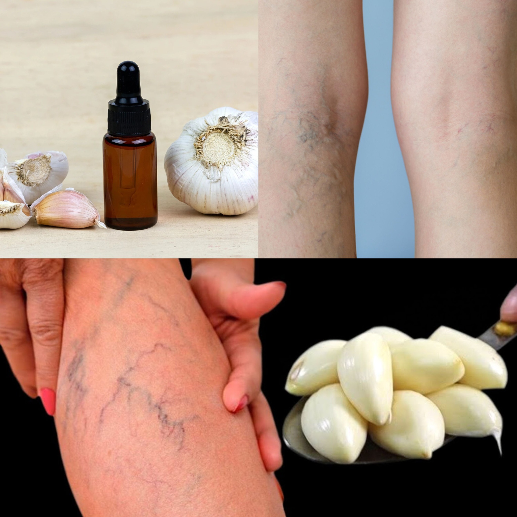 Garlic An All-Natural Treatment for Arthritis, Rheumatism, Varicose Veins, 1