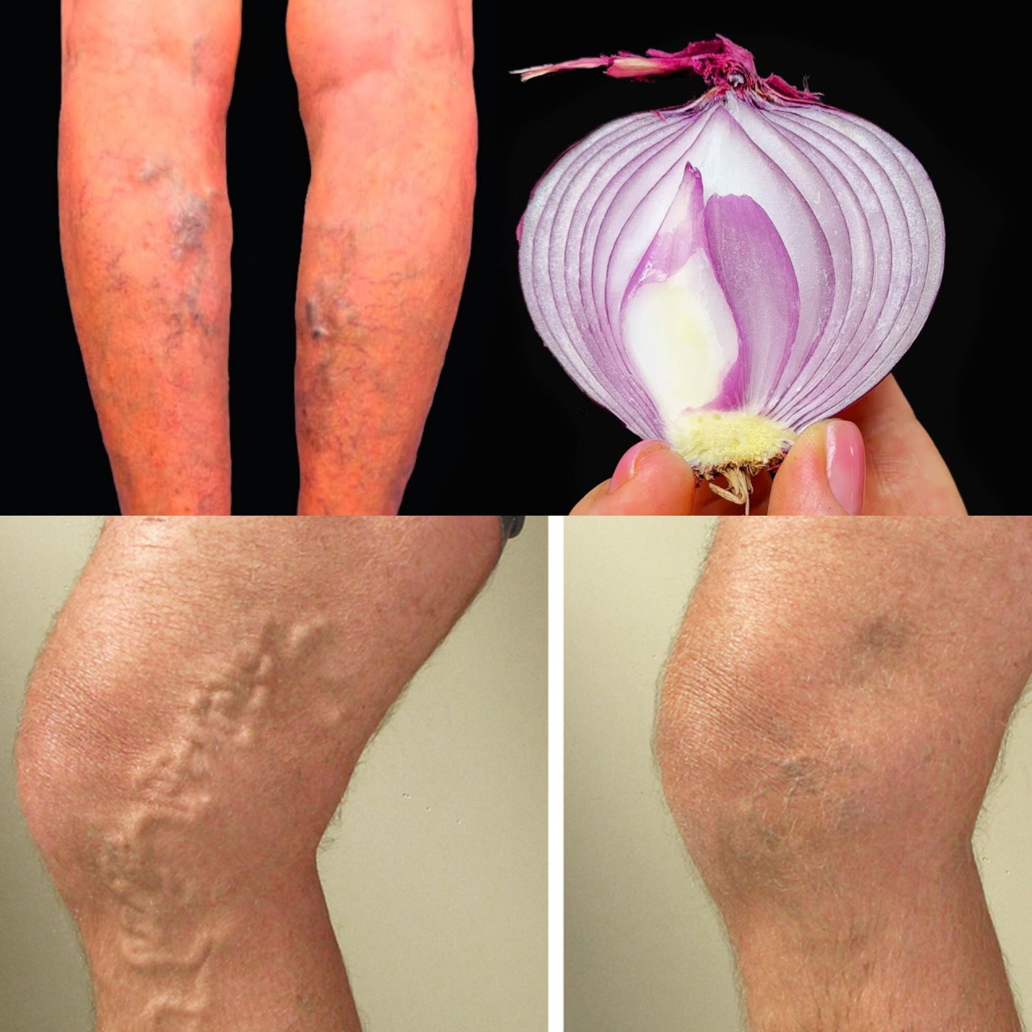 Two Onion Recipes to Kill Varicose Veins Like an Eraser 1