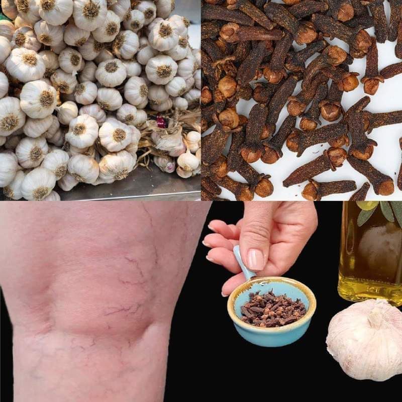 Use Garlic and Cloves to Reduce Varicose Veins, and Leg Pain 1
