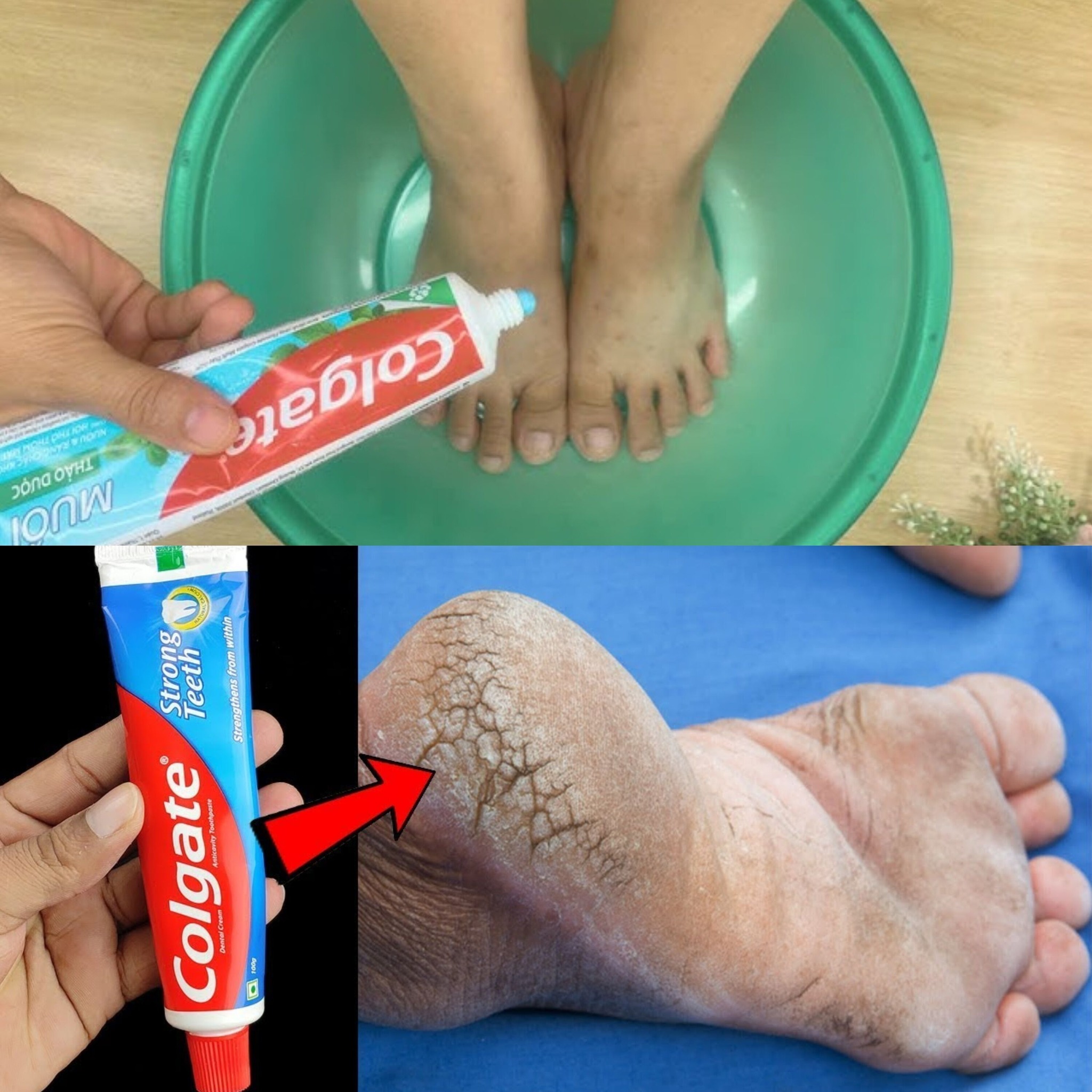 Use toothpaste as a home remedy to remove cracked heels 1