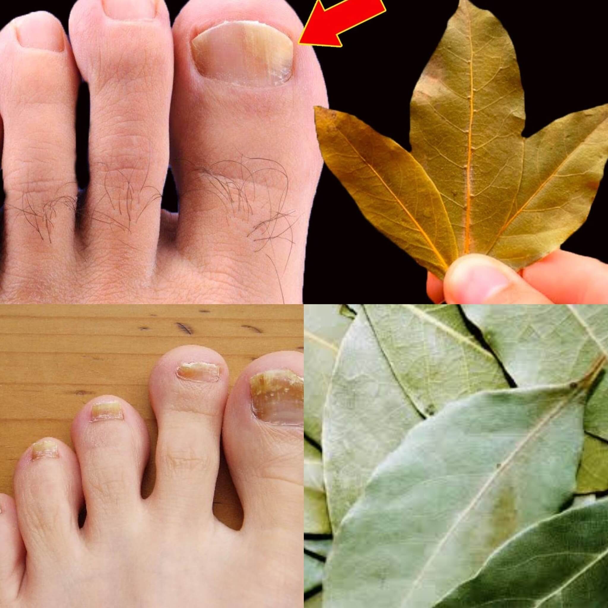 Bay leaves are a natural remedy that can be used to get rid of nail fungus. 1