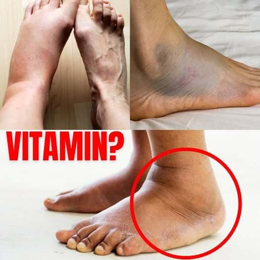 This Vitamin Removes Swelling in the Feet and Legs  1