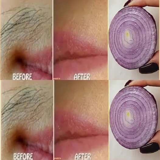 Use Just One Onion to Permanently Remove Face Hair 1