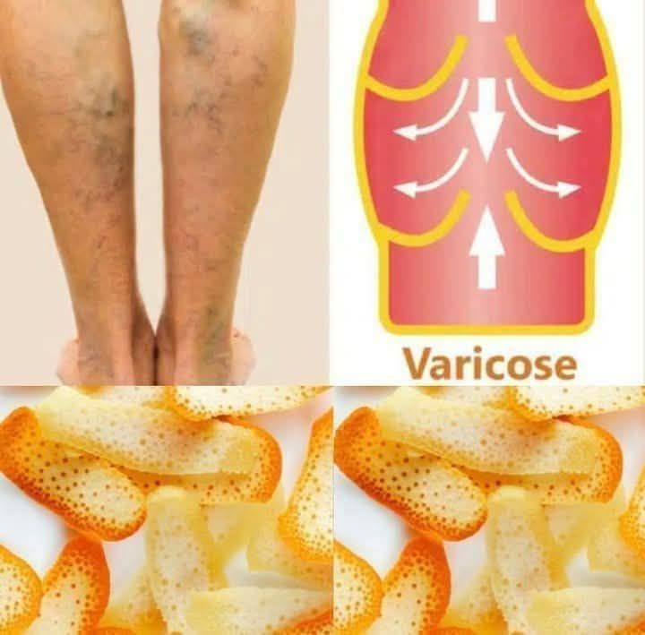 Orange peel helps boost circulation and reduce swelling, making it a great natural remedy for varicose veins. 1 Orange peel helps boost circulation and reduce swelling, making it a great natural remedy for varicose veins.