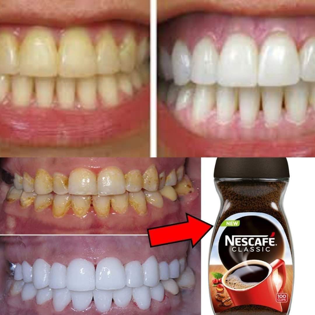 Teeth whitening at home in a natural and effective way in two minutes and a bright smile 1