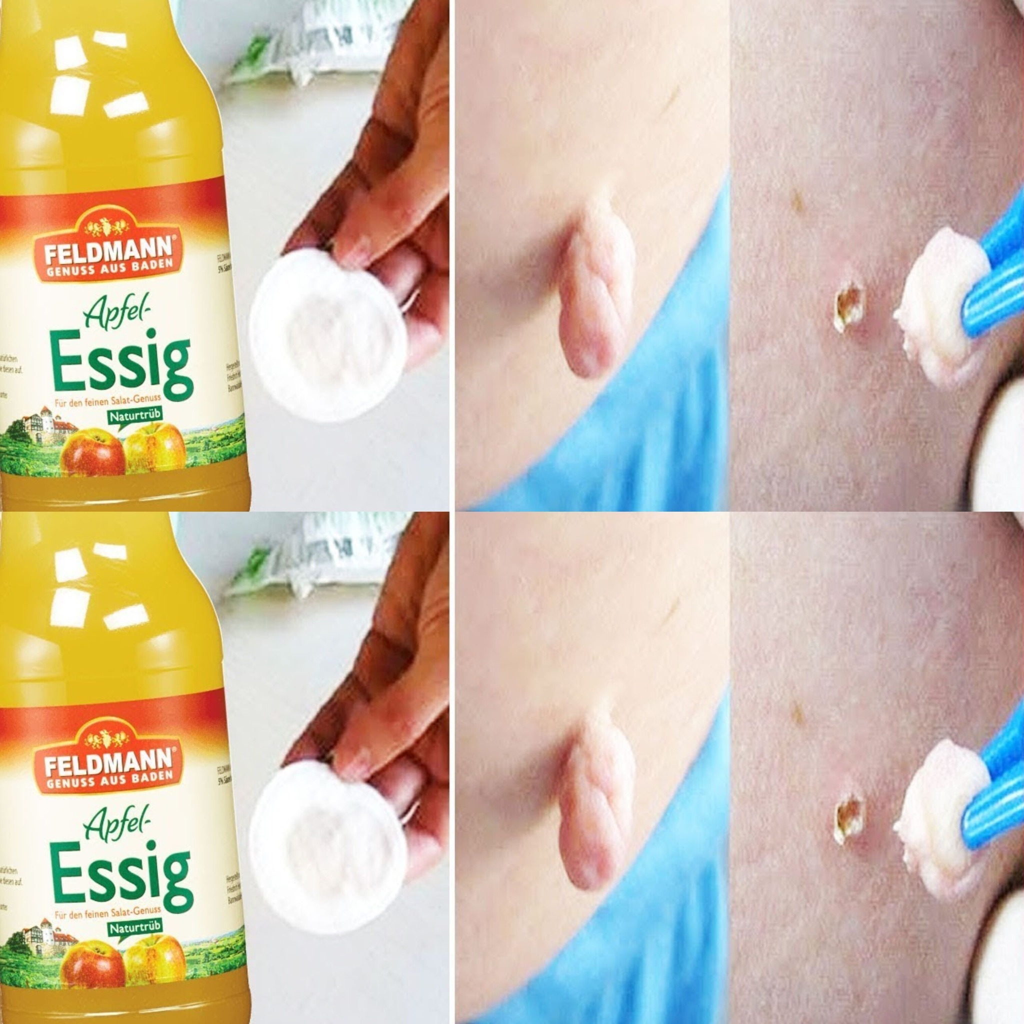 How to Naturally Get Rid of Warts! 1