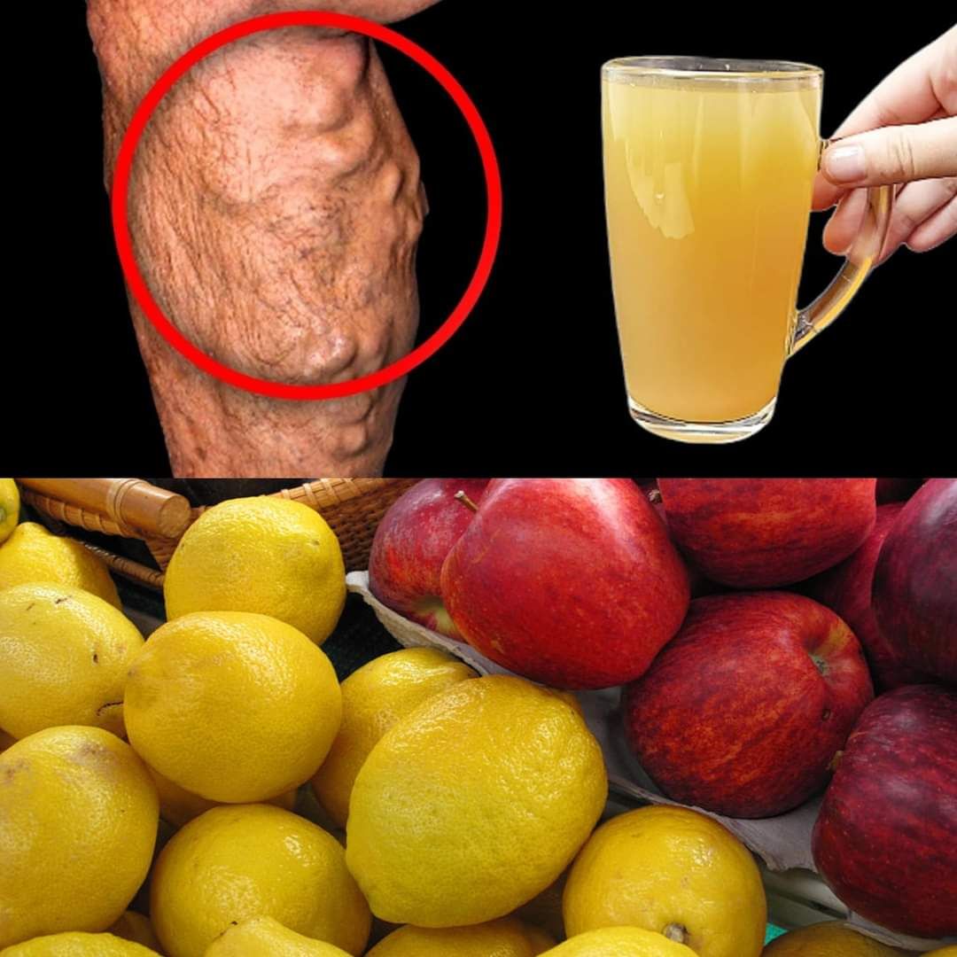 Use apple and lemon juice to dissolve blood clots 1