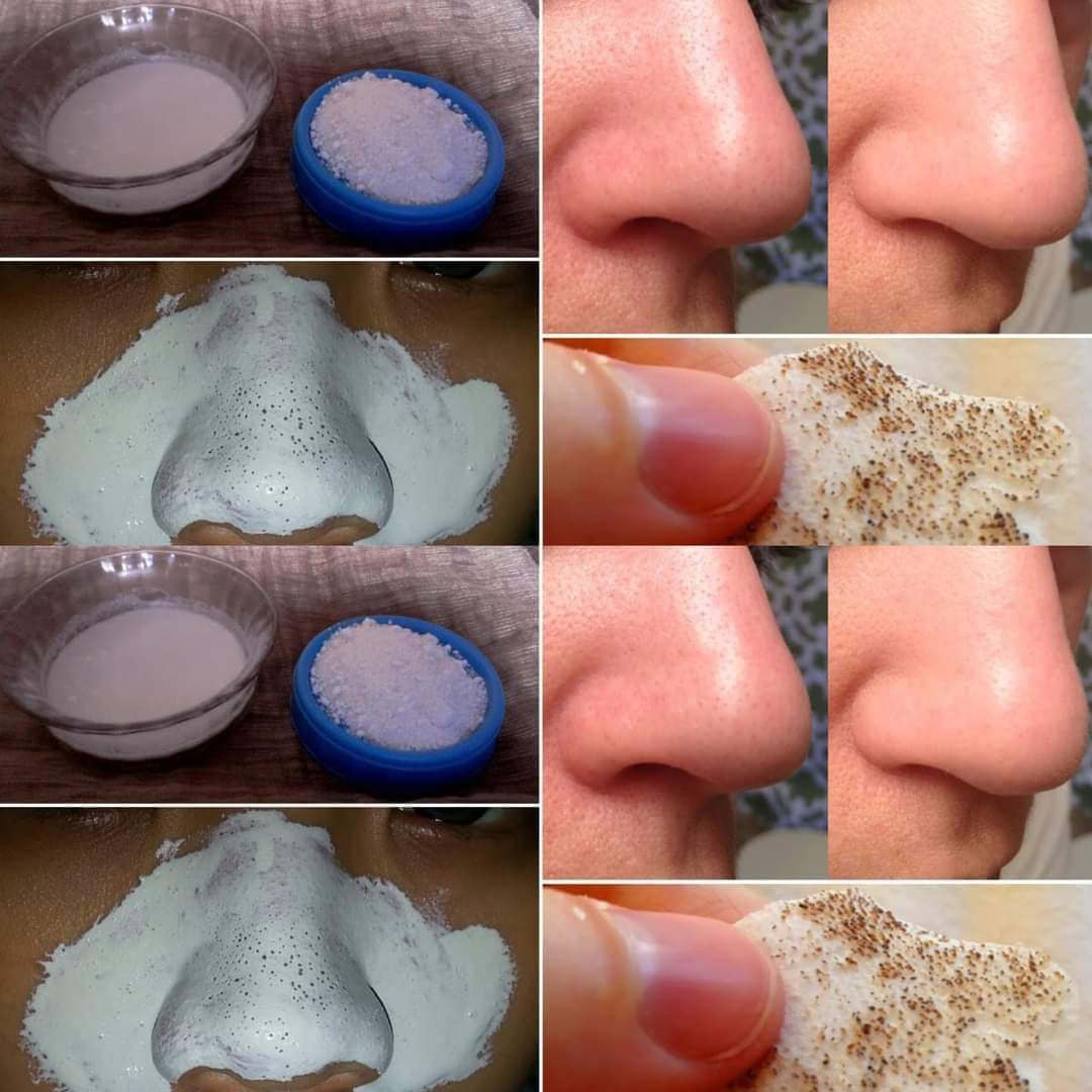 How to Remove Blackheads Naturally 1