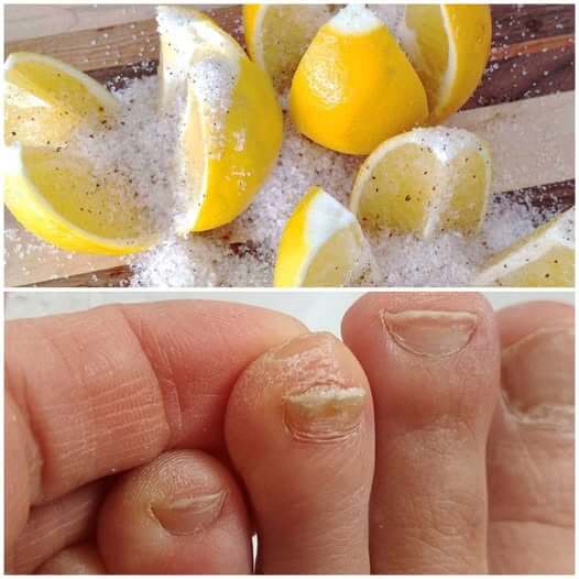 Using Lemon and Salt as a 100% Natural Treatment for Toenail Fungus 1