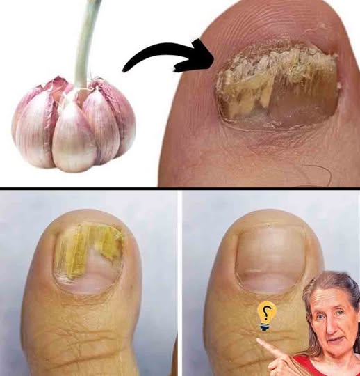 How Garlic Helps Eliminate Fungal Foot Infections Naturally 9