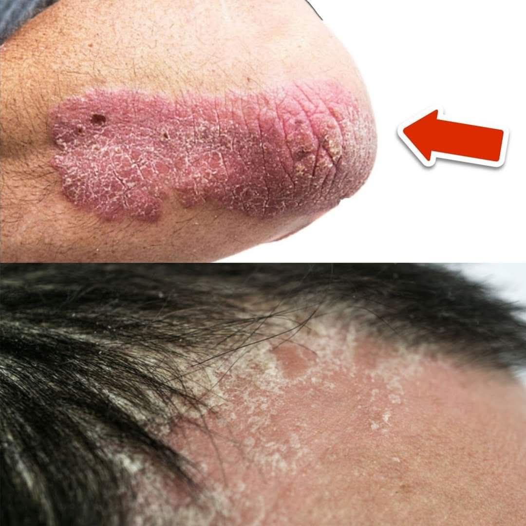 This Vitamin Permanently Eliminates Psoriasis 3