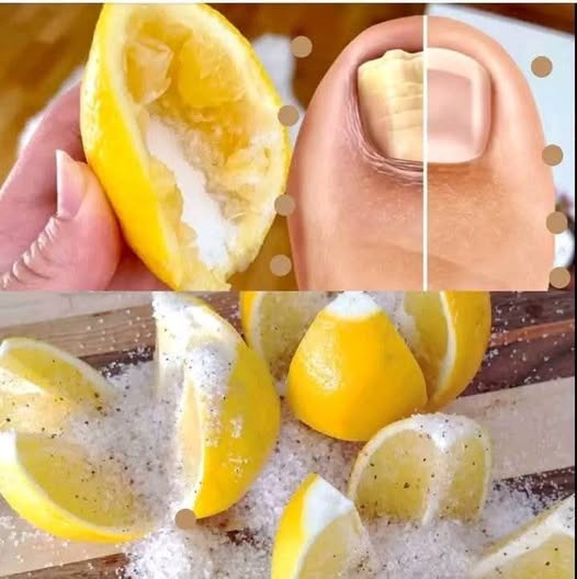 Using salt and lemon as a 100% natural cure to remove nail fungus 3