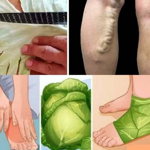 Using Cabbage Leaves to Treat Varicose Veins Naturally 2