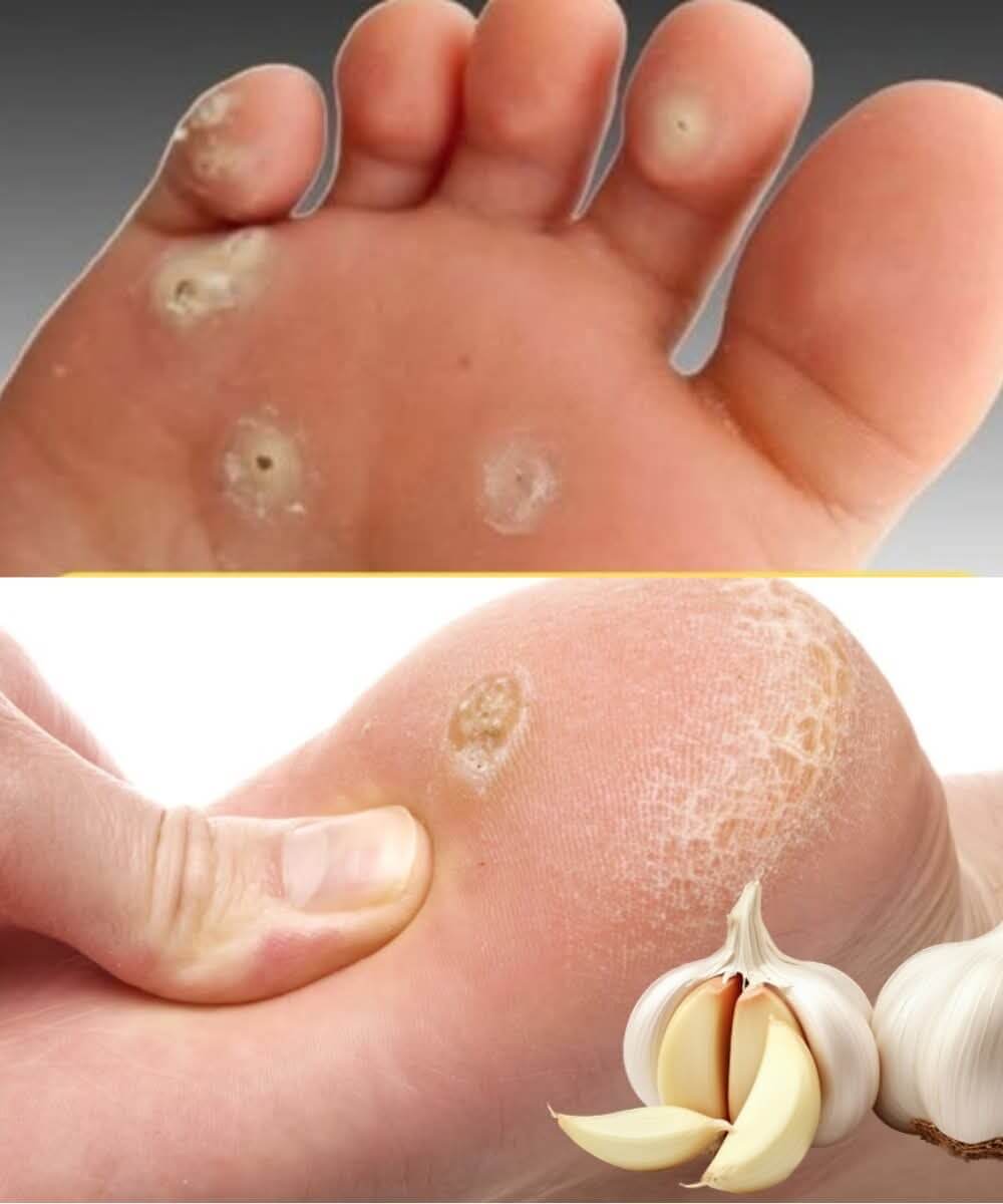 Eliminate Plantar Warts with These Natural Garlic Remedies 1