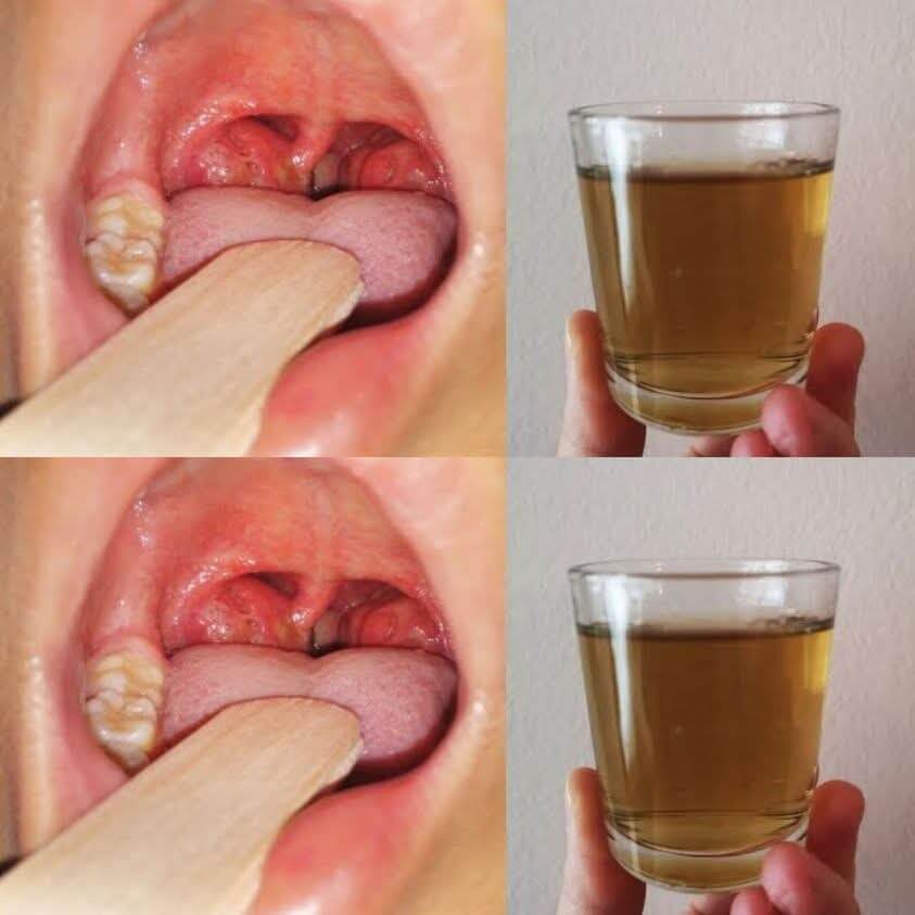 Swift Relief: Easy Recipes to Vanquish Throat Pain and Inflammation 1