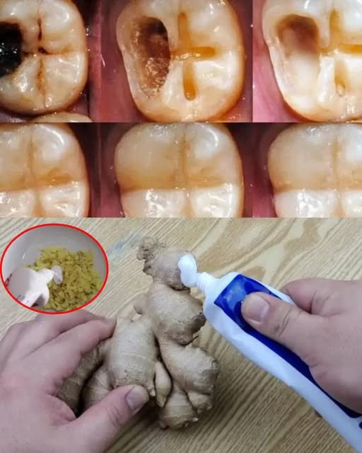 How to Naturally Repair a Cavity & Strengthen Your Teeth 1