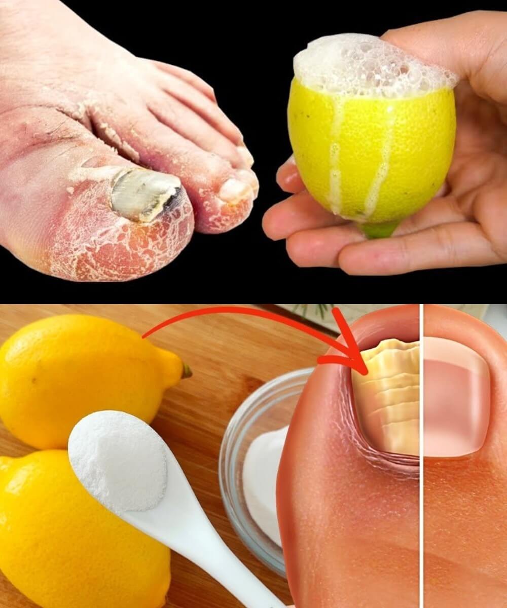 100% Natural Remedy for Toenail Fungus Removal with Lemon & Salt 1
