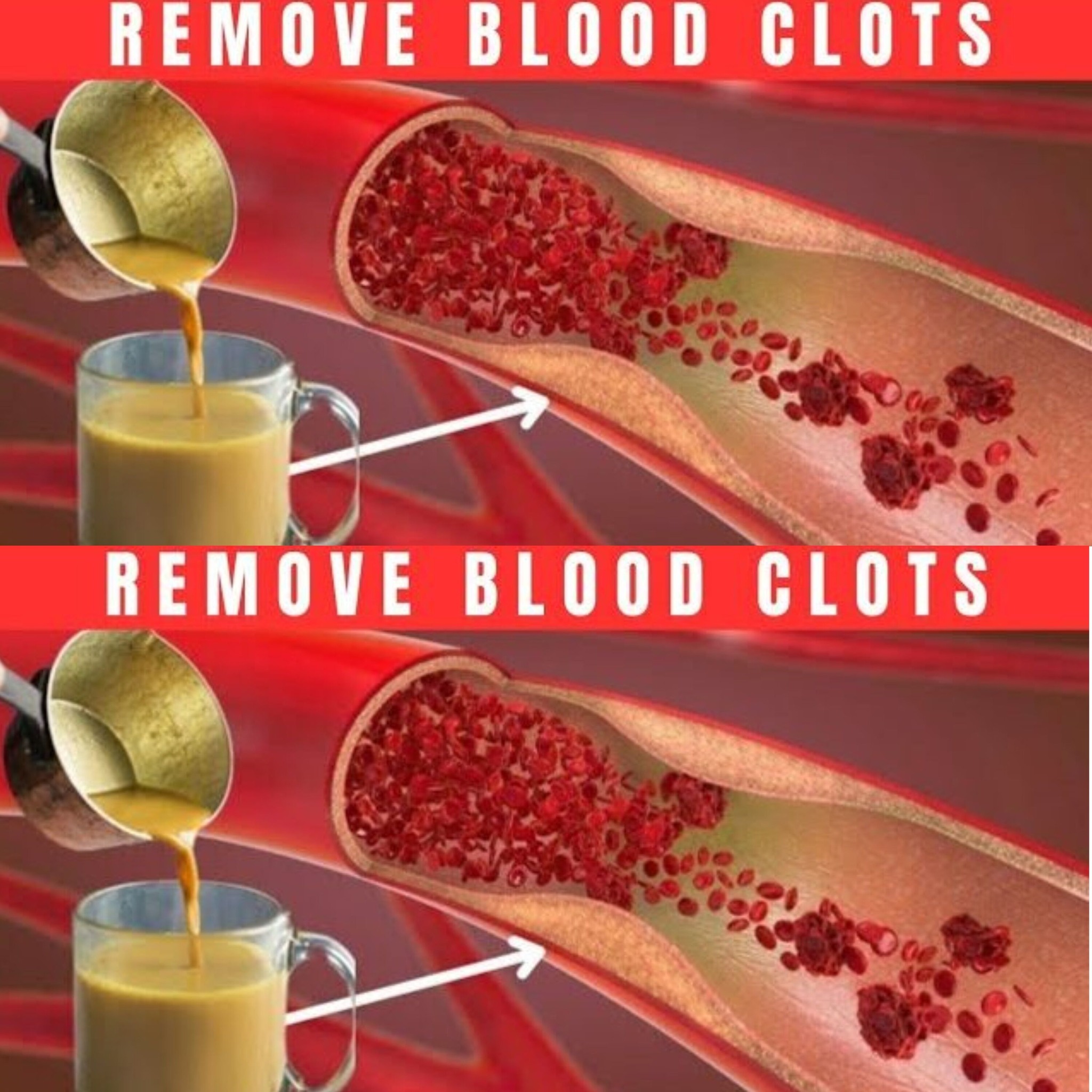 Drink a cup of turmeric and ginger every day to prevent blood clots. 1
