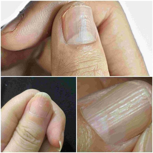 The ACTUAL Reasons Behind Your Nails' Vertical Ridges 1