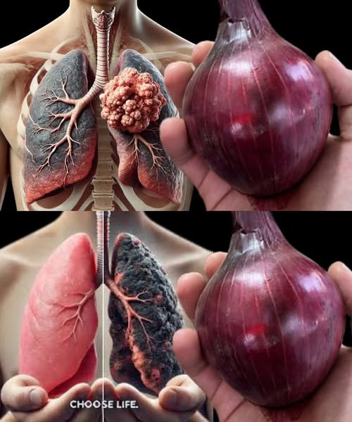 Onion Remedy for Lung Cleansing & Cough Relief 1