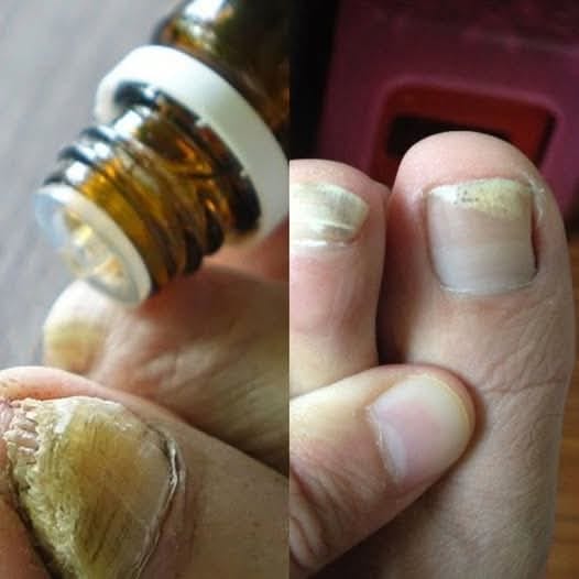 The Miracle Solution to Permanently Kill Toenail Fungus: Apple Cider Vinegar & Tea Tree Oil Soak 1