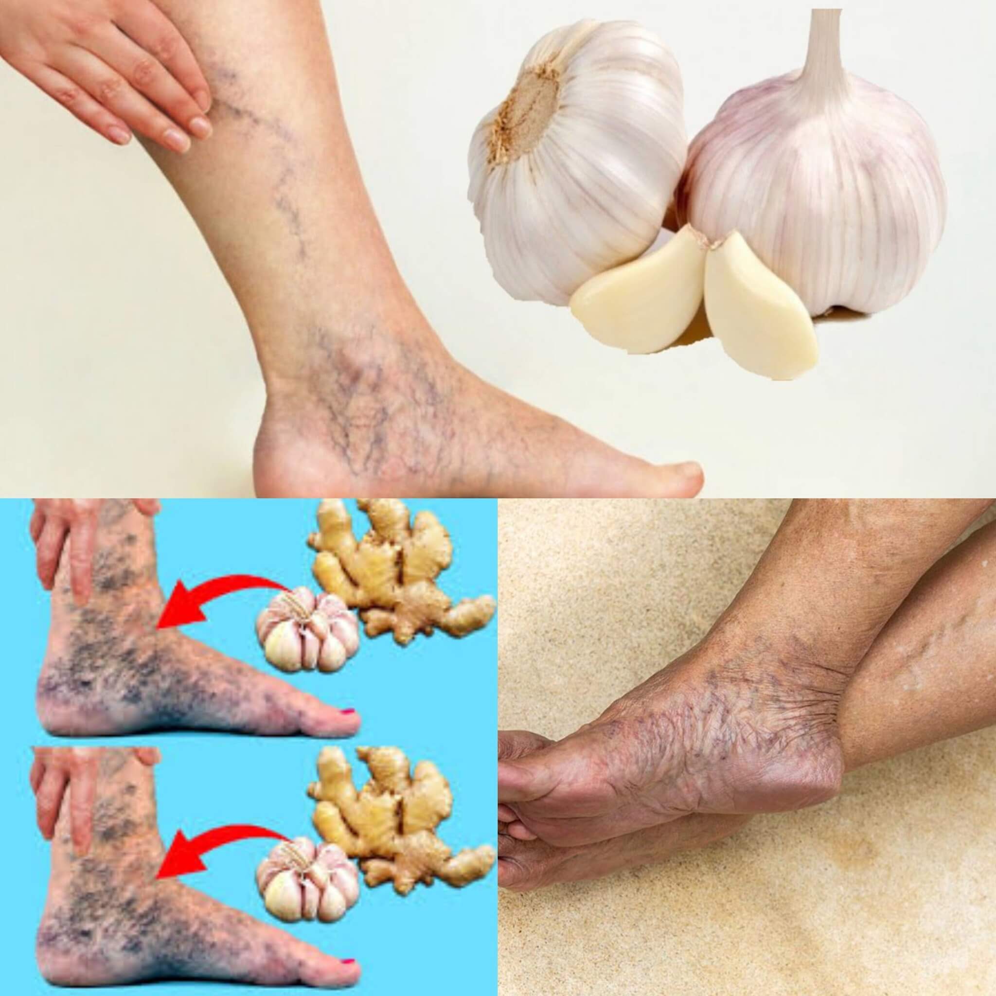 Say Goodbye to Varicose Veins with These 2 1