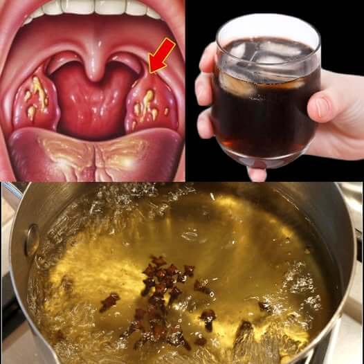 Cloves: Nature’s Antibiotic – Kill Sore Throat & Inflammation 1