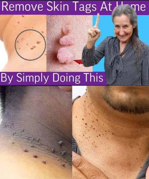 Plantar Warts and Skin Tags Disappear Overnight with This Natural Home Remedy 1
