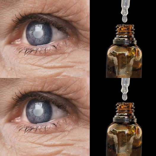 Rosemary Eye Drops: Natural Remedy That May Help With Cataracts, Vision & Inflammation 1