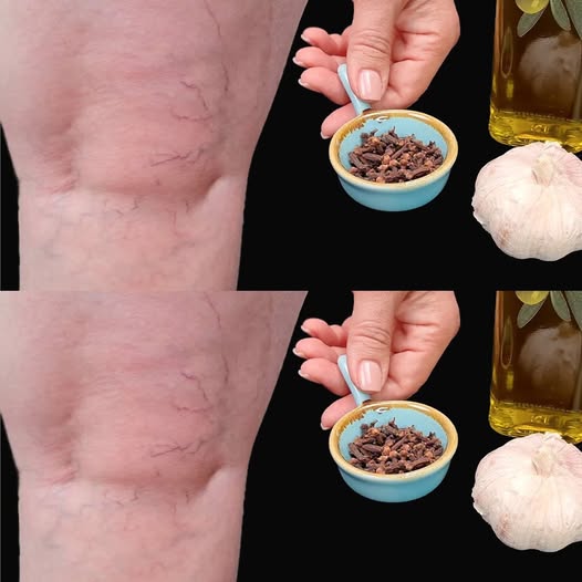 Natural Remedy with Cloves & Garlic for Leg Pain 1