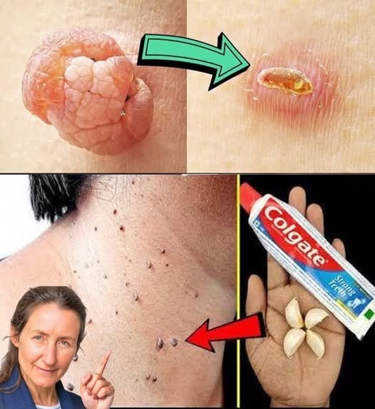 🌿 Natural Overnight Remedies for Plantar Warts and Skin Tags 1