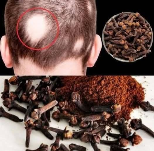 Clove Oil Hair Treatment: For Stronger, Longer, Healthier Hair 1