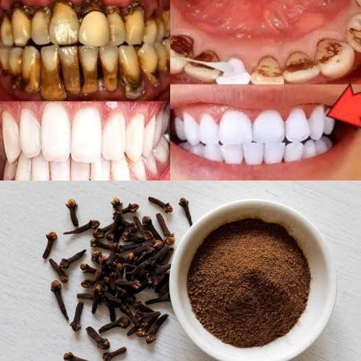 Unlock the Secret to Healthier Teeth with The Oral Care Benefits of Chewing Cloves Daily 1