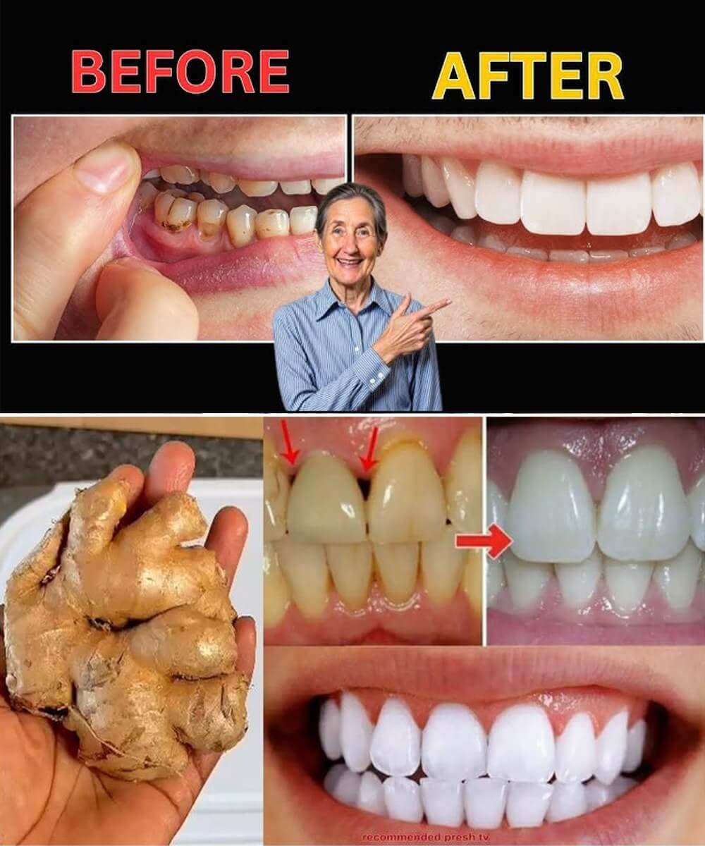 How Ginger and Baking Soda May Help Reduce Plaque Buildup 1