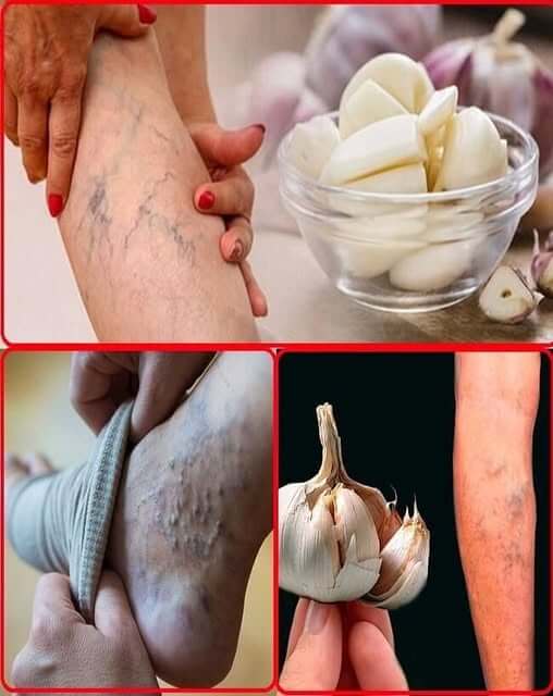 My Mother’s Secret: Garlic Remedy for Aches and Pains 1