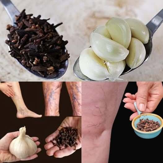 Soothe Leg Pain and Rheumatism with This Natural Remedy 1