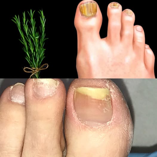 Say Goodbye to Nail Fungus with Rosemary – A Natural Remedy 1