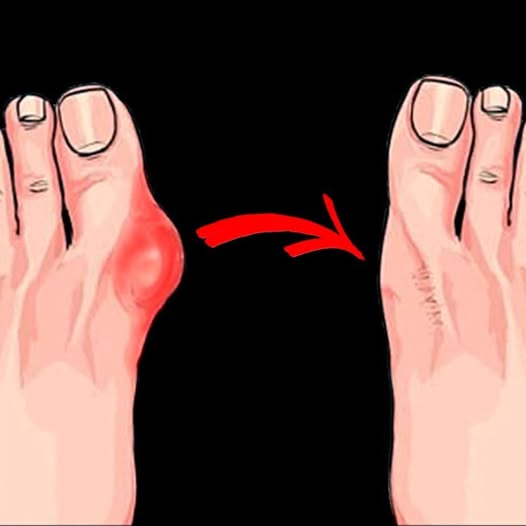Natural Methods to Ease Foot Bumps and Bone Protrusions 1