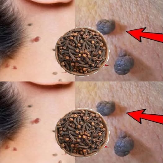 Cloves: A Natural Solution for Skin Tags and Warts 1