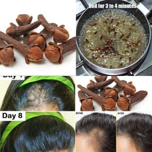 Grow Hair at Rocket Speed and Treat Baldness  Starting from Week One with Cloves 1